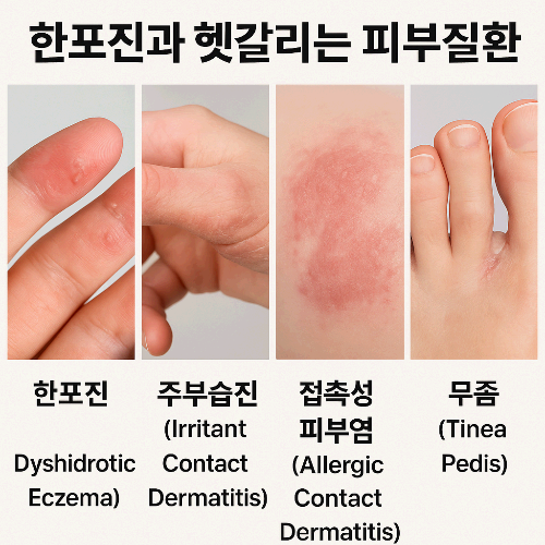 한포진과 헷갈리는 피부질환 3가지 비교