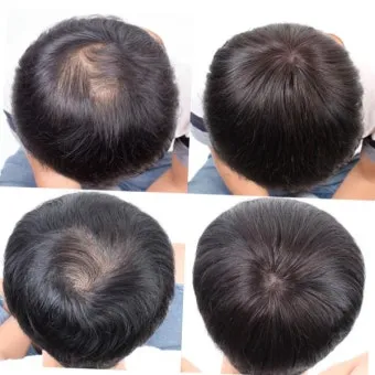 정수리가 아픈 이유와 완화하는 방법_16