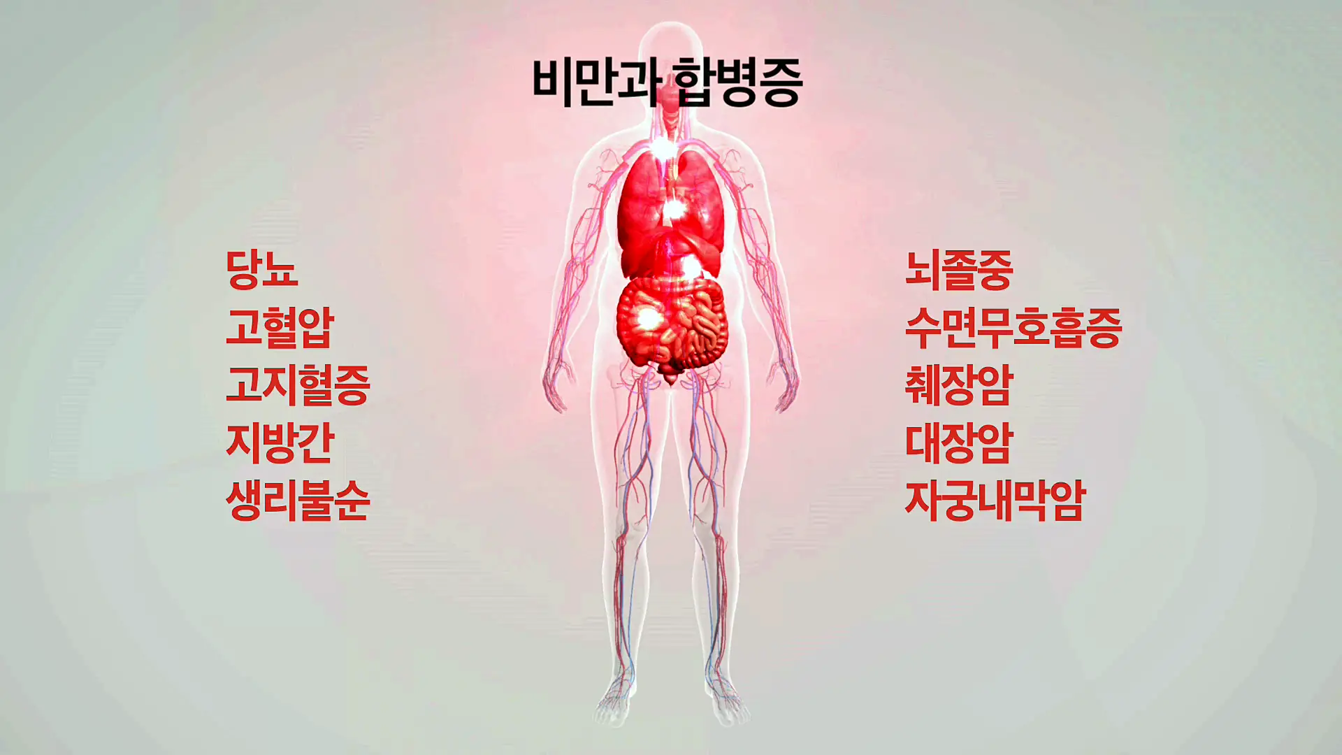 KBS 생로병사의 비밀 827회 최후의 다이어트 고도비만 위절제 수술, 위우회술 수술 차이점과 의료보험 대상 조건