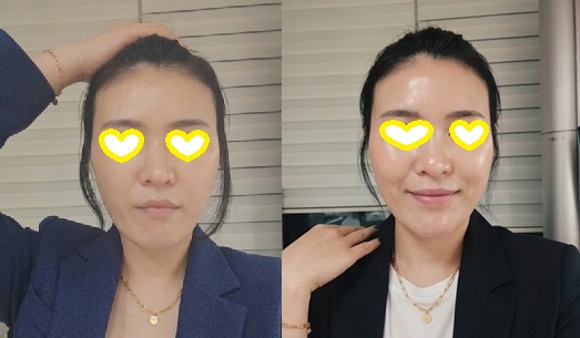 엑소좀 시술 전후 비교 사진. 왼쪽은 탄력이 떨어진 피부, 오른쪽은 1주일 후 피부결과 톤이 개선된 내돈내산 실제 후기 모습.