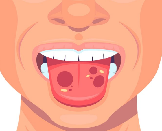 혓바닥 질병