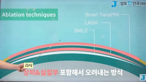 라식 수술이 가능한 나이