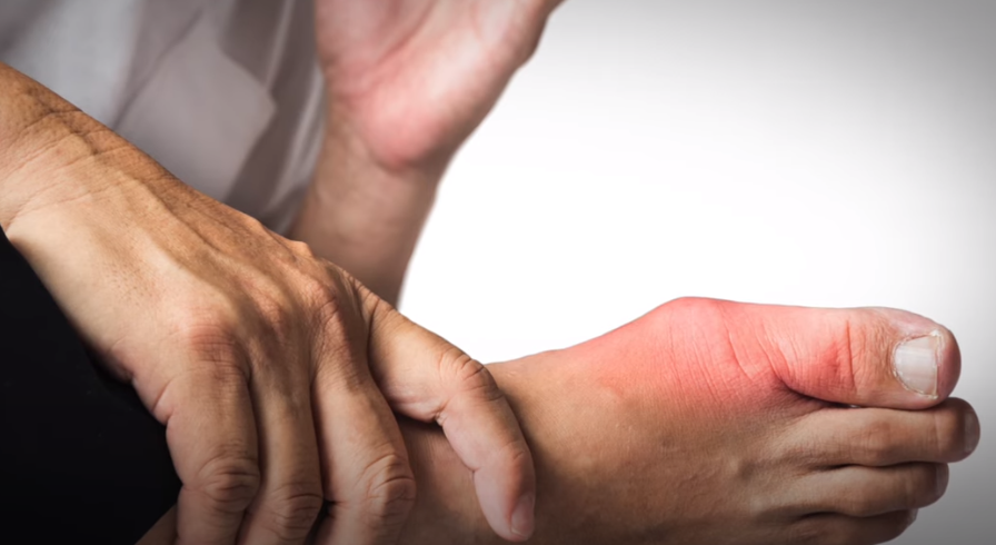 통풍 증상과 치료방법