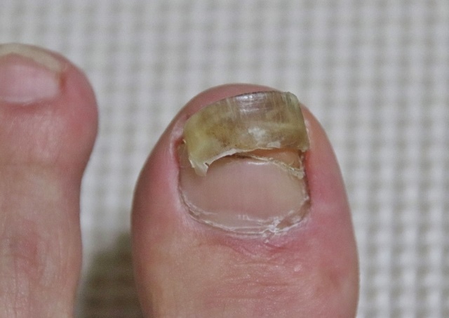 무좀이-걸려-발톱이-상한모습
