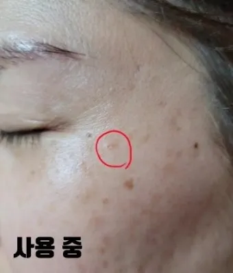 비립종 생기는 이유 비립종 없애는 방법 피부 관리법_20