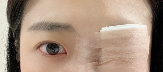 투데이 라섹 후기