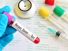 대상포진 예방접종 가격