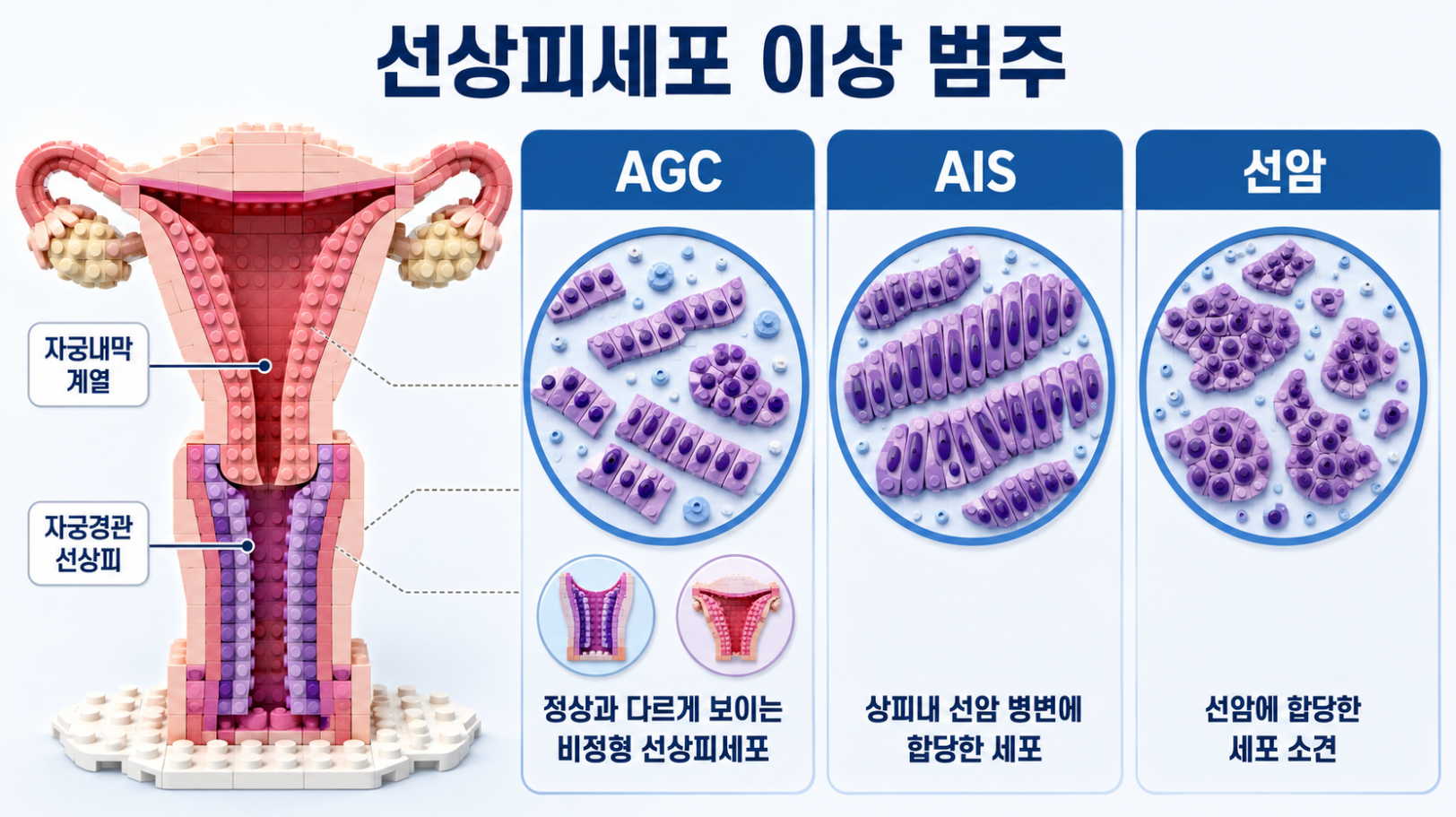 AGC, AIS와 선암의 선상피세포 이상 범주 및 자궁경관&middot;자궁내막 계열을 설명한 인포그래픽