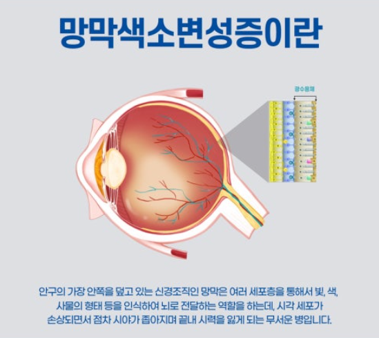 망막색소변성증의 유전적 원인, 증상,예방, 관리법 관련 이미지