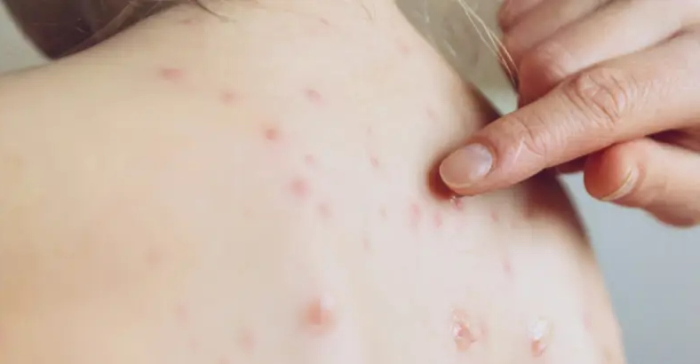 대상포진 발진 사진