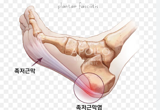 족저근막염의 원인 증상과 해결 방법