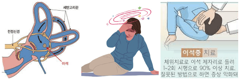 이석증 관련 사진 3개