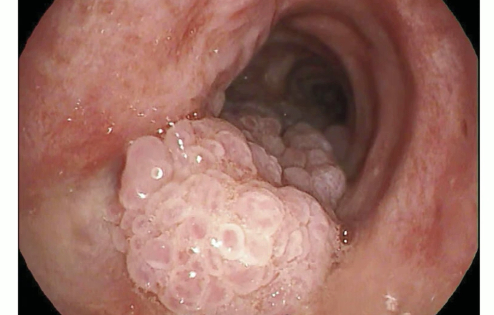 hpv 바이러스 증상