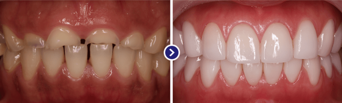 미니쉬 시술 과정