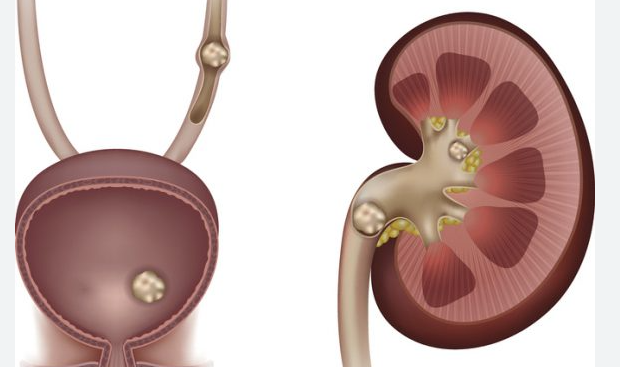 과다 섭취 시 나타나는 부작용 : 신장결석, 철분과잉, 위장장애