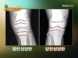 성장판 닫혀도 키 클 수 있는 방법과 성장 호르몬 시기_6