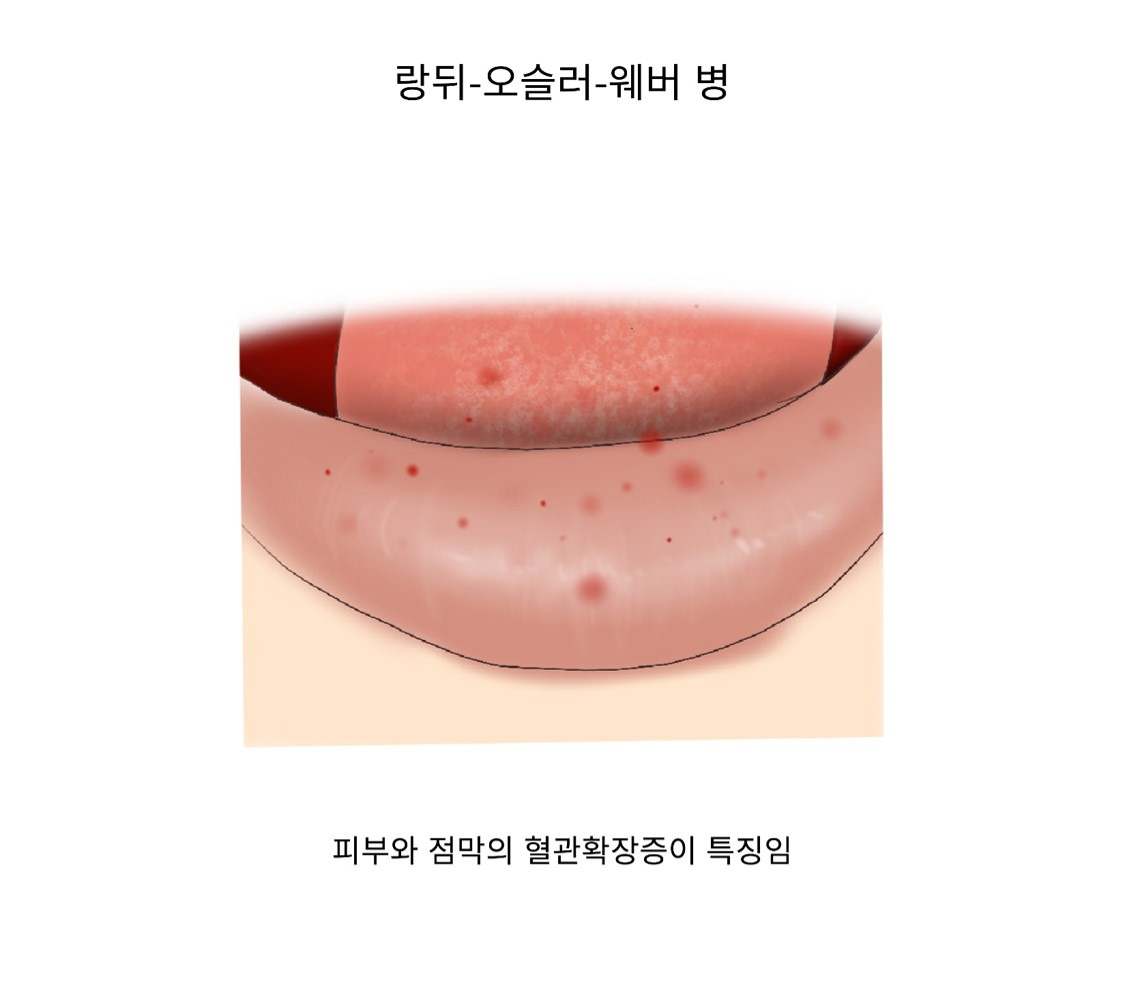유전성 출혈성 혈관확장증