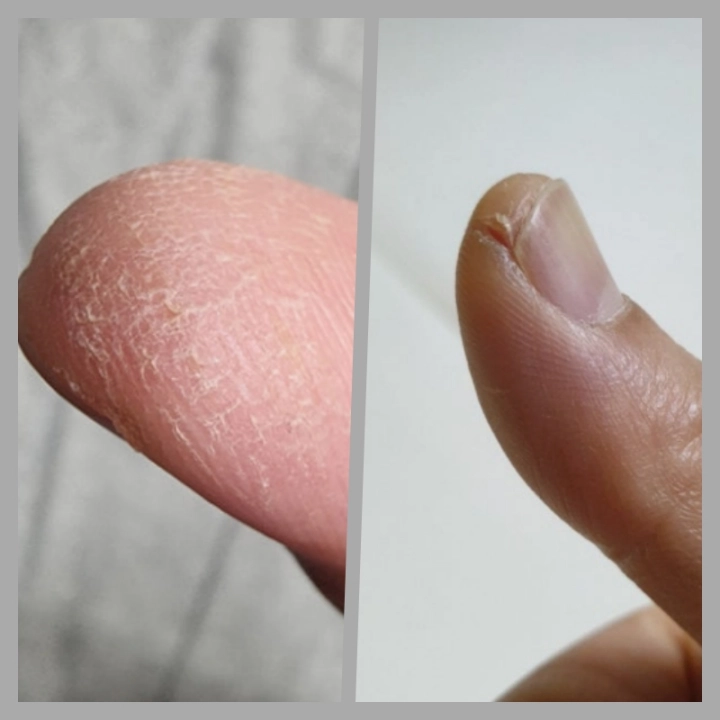 손끝-갈라짐과-습진