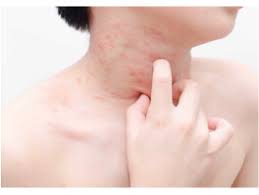 음식물 과민증 검사는 어디서 받나요?-환자