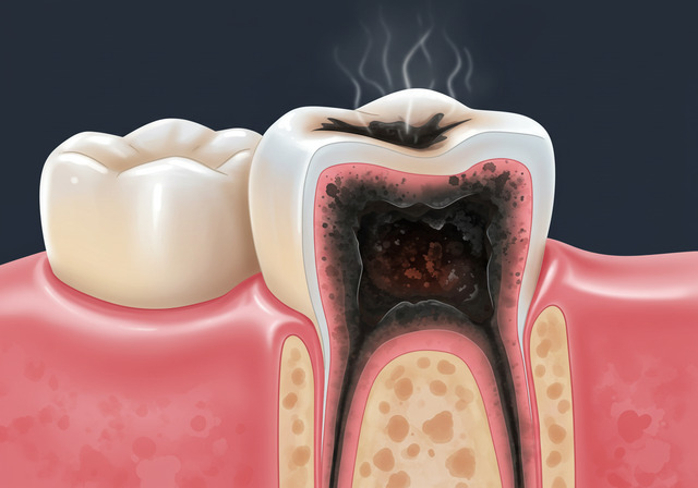 충치 냄새 나는 이유