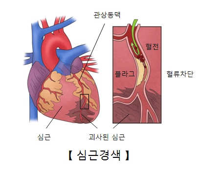 심근경색 이미지