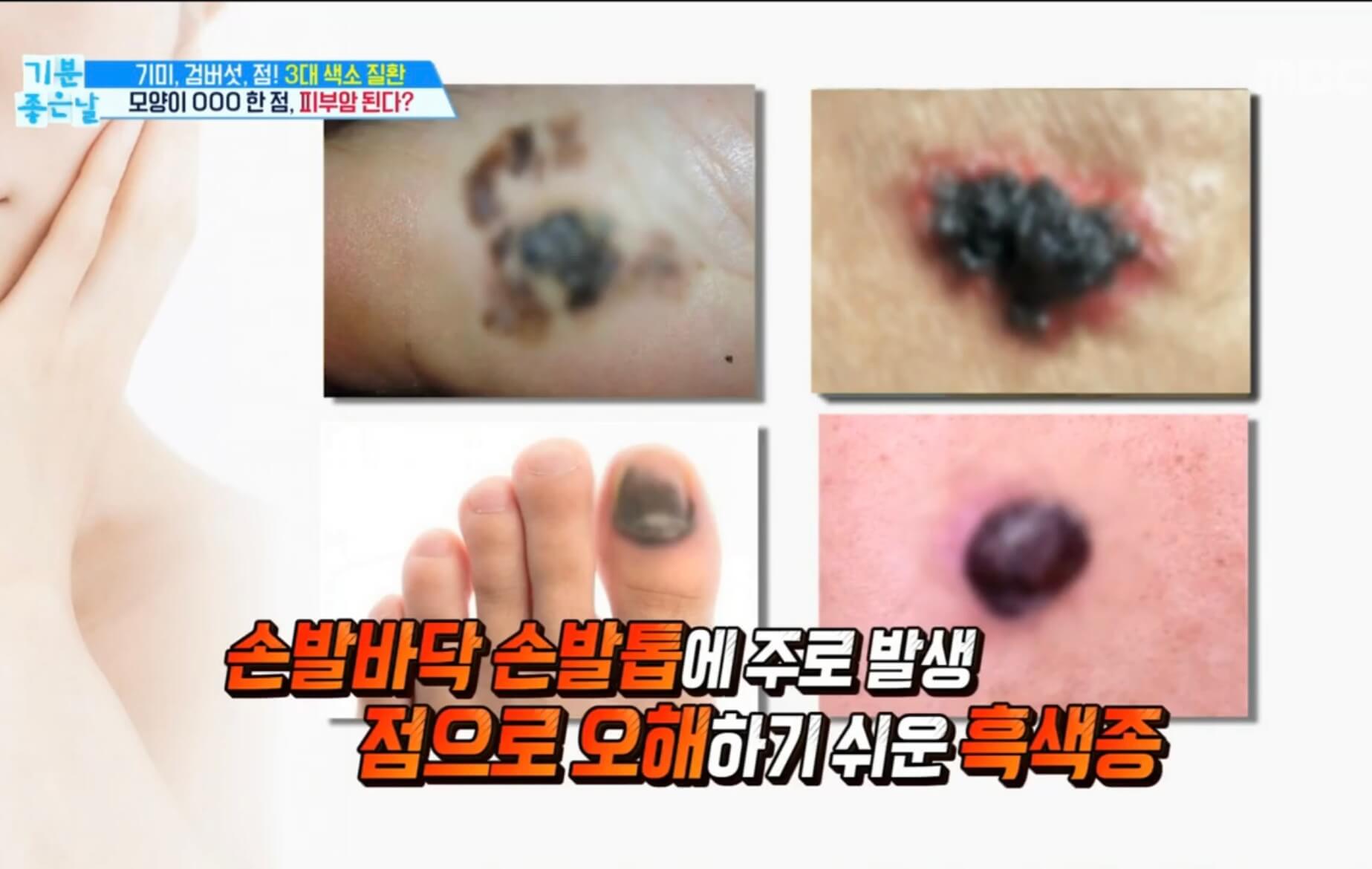 피부암