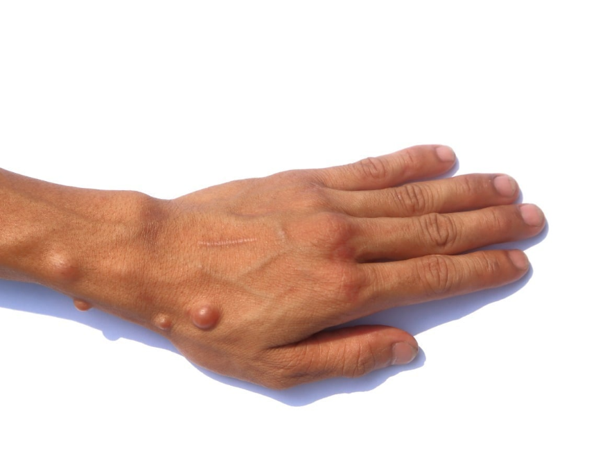 신경섬유종 초기 증상, 혹시 나도? 놓치면 안 되는 신호