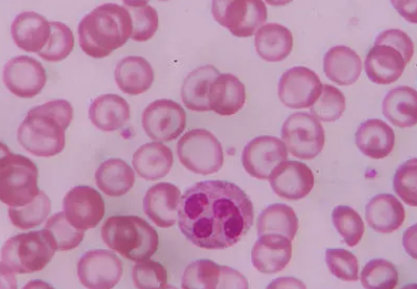 백혈구 수치가 낮은 이유 12가지 총정리 섬네일