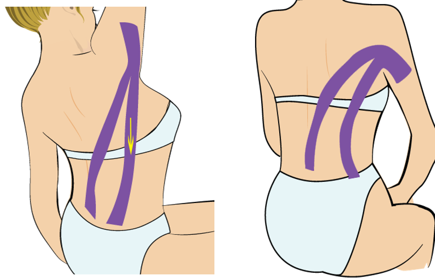 견갑골 외측 통증