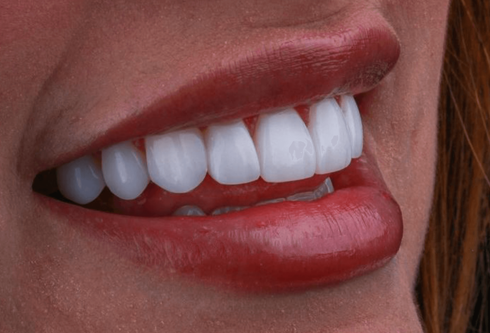 앞니 지르코니아