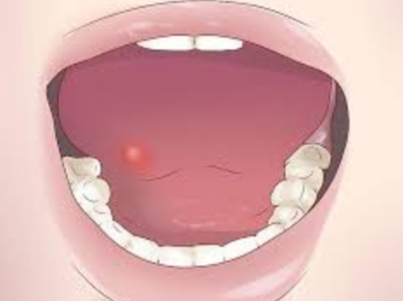 구강암 치료 후 회복과정