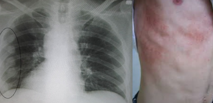 갈비뼈금간-사진7