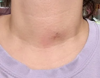 갑상선 기능 저하증 증상 6가지는 무엇인지 알아보기_18