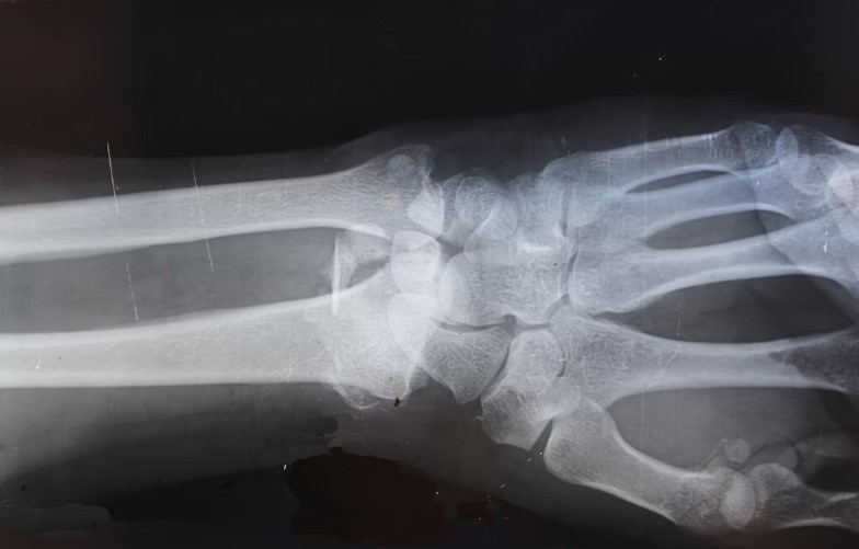 류마티스 관절염 치료법