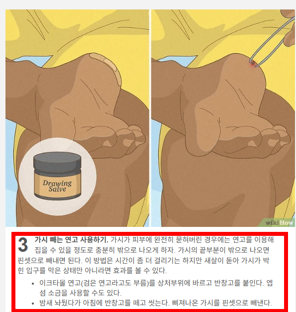 손가락 가시 빼는법 소개