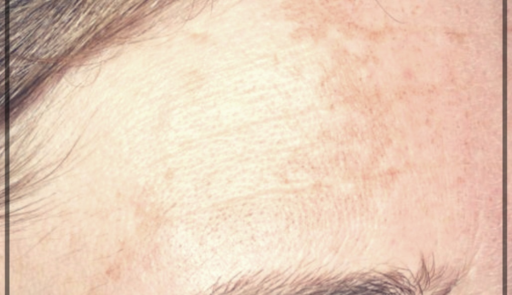 후천성 오타모반 이란?기미. 주금깨 주범.