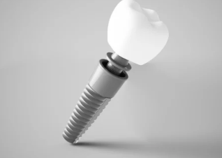 임플란트 모형 사진