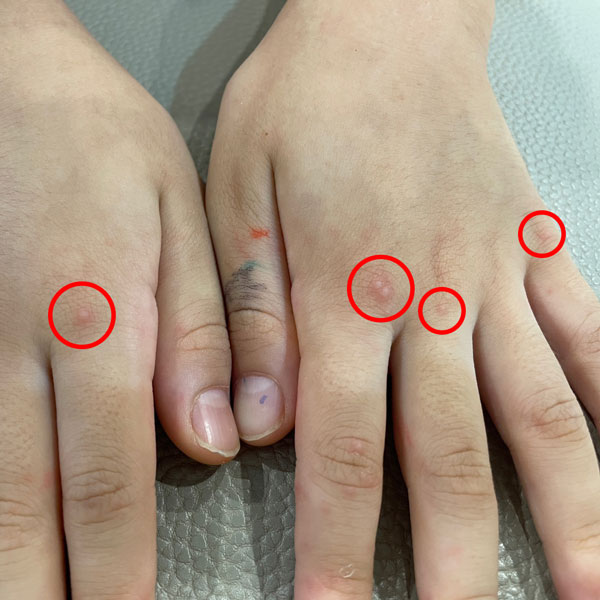 수족구 증상, 초기증상, 약, 격리기간 총정리