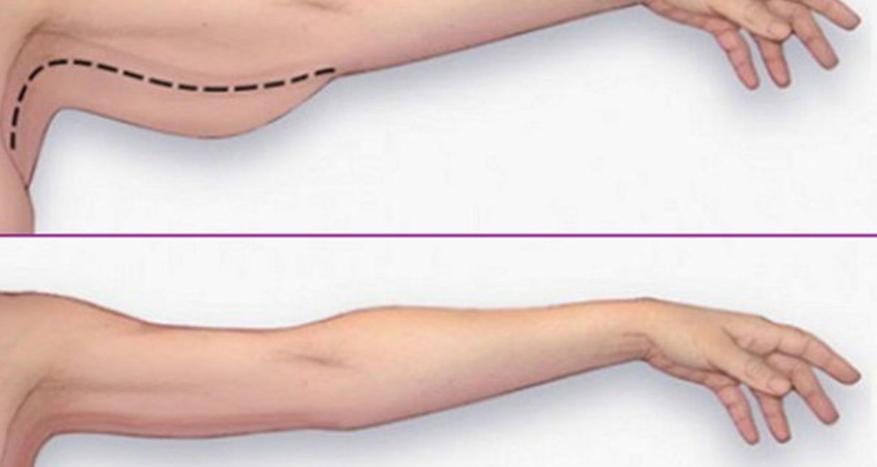 팔뚝 안쪽살 빼기1