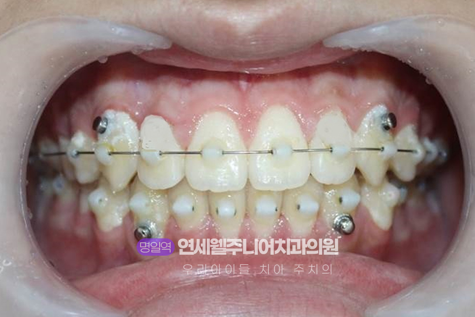 개방교합 교정 과정에서 위아래 치아에 MTA 미니튜브와 교정용 버튼 및 와이어를 부착한 모습