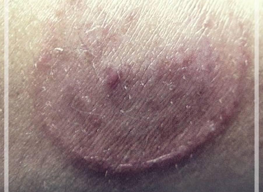 체부백선: 이해, 치료법, 그리고 관리