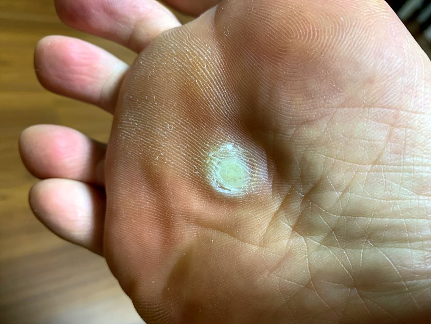 앤트와츠 두번째 도포 후 6일이 지난 발바닥은 사마귀가 흰색으로 불어서 금방이라도 뚜껑이 떨어질 것 같아 보입니다.