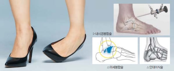 발목 염좌 후 발목보호대 추천 재활 착용법