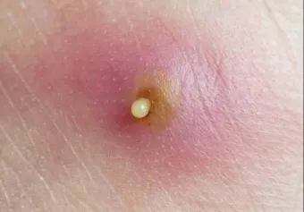 엉덩이 종기가 생기는 이유 왜 생기고 어떻게 관리할까요 완벽 가이드_4