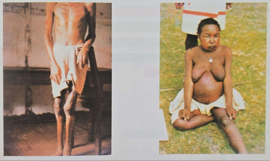 건성각기, 습성각기