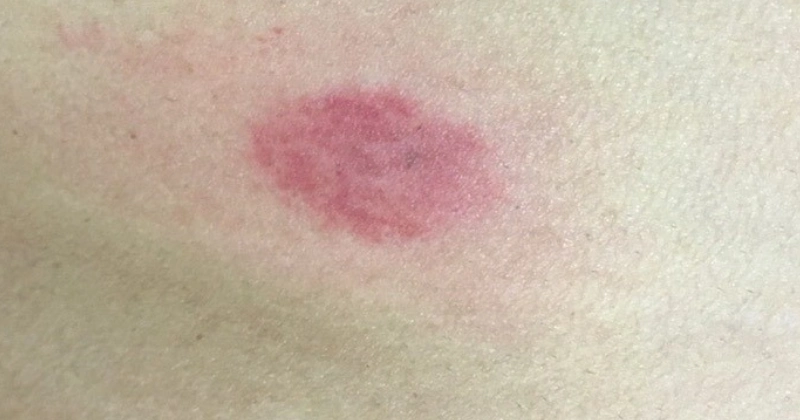 진드기 물린 자국