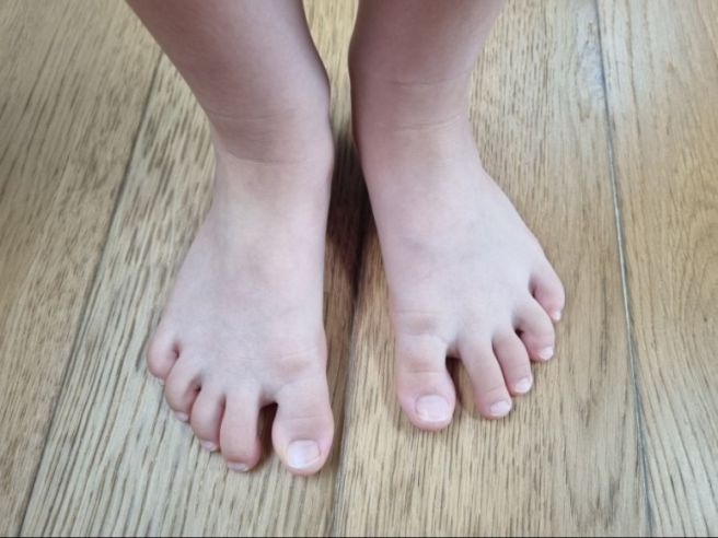 발등이 아픈 이유