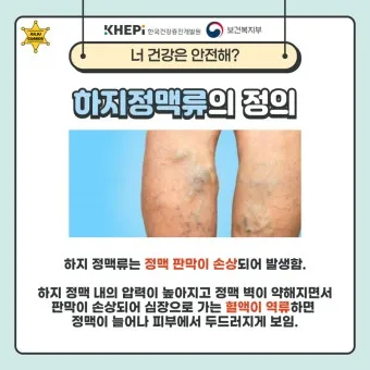 하지 정맥류 증상 치료방법과 예방 생활습관_11