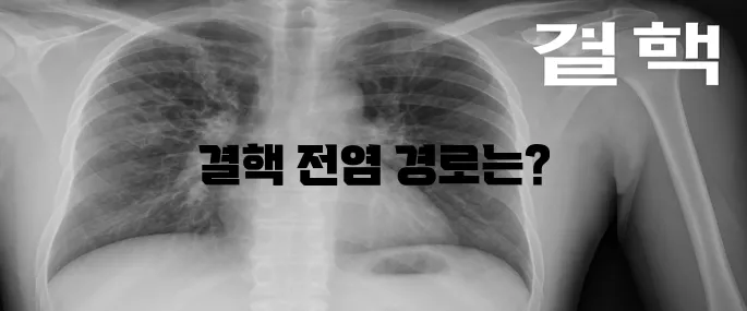결핵의 전염성에 대해 알아보자