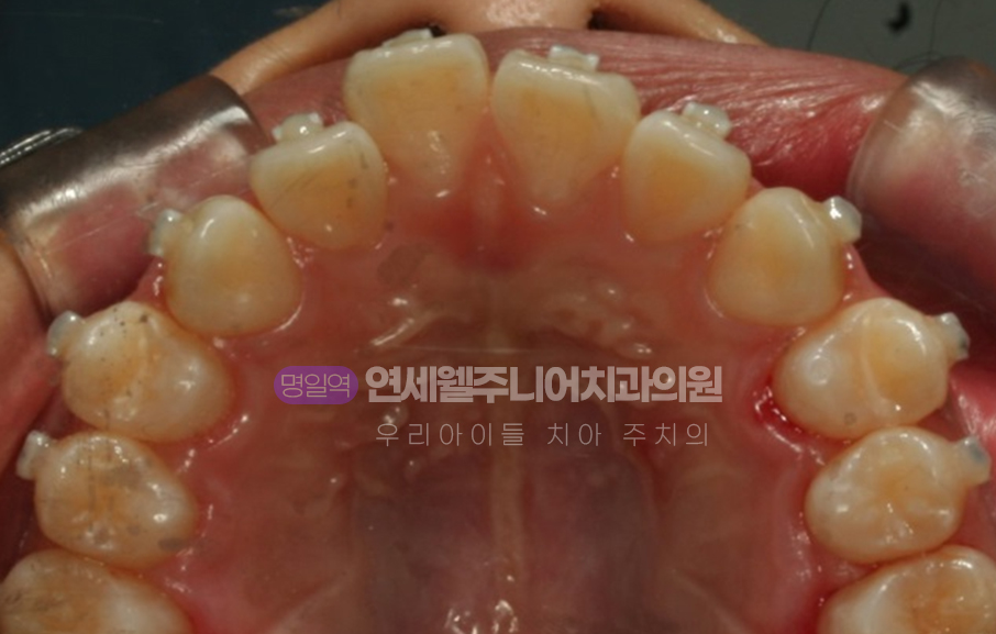 MTA 미니튜브 교정 초기 치아 겹침과 불규칙한 배열을 보여주는 위턱 교합면 사진